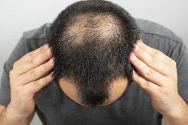 Growth Hormone Deficiency and Hair Loss